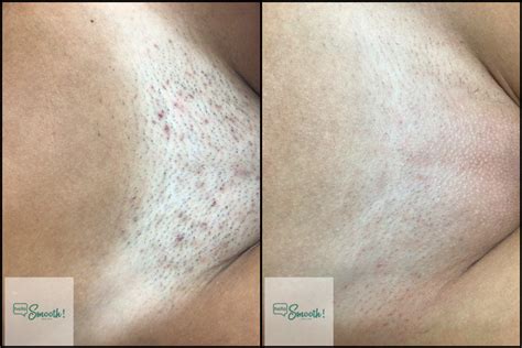 laser hair removal brazilian wax
